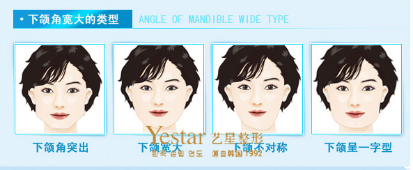 浠水华亚做韩式双眼皮一般多少钱?好不好看呢